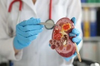 Tin mới y tế ngày 21/1: Đau thắt lưng kéo dài, phát hiện ung thư thận giai đoạn sớm