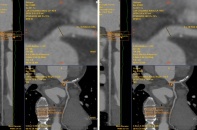 Đau tức ngực ban đêm cảnh báo bệnh tim mạch mạn tính nguy hiểm