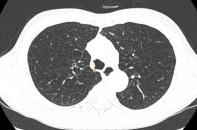 Hút thuốc nhiều năm, dấu hiệu khó thở báo động bệnh phổi mạn tính