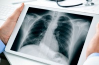 Tin mới y tế ngày 9/3: Phát hiện ung thư phổi hiếm gặp từ khối u không triệu chứng