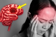Đau đầu kéo dài, cô gái 31 tuổi phát hiện áp xe não