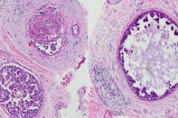 Chưa từng tầm soát, người phụ nữ 41 tuổi phát hiện ung thư ngay lần đầu đi khám