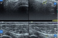 Chủ quan với cơn đau vai, người phụ nữ bất ngờ phát hiện rách gân