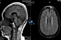 Đau đầu kéo dài, người phụ nữ phát hiện bệnh thần kinh ít được chú ý