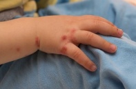 Dịch tay chân miệng tại TP.HCM tăng cao