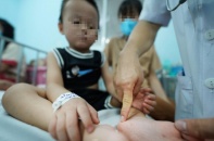 Tay chân miệng ghi nhận trẻ tử vong, Bộ Y tế yêu cầu siết điều trị trên toàn quốc
