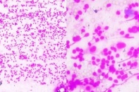 Hạch vùng cổ bất thường, cảnh báo nguy cơ ung thư hạch Hodgkin