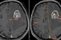 Dấu hiệu yếu tay tưởng nhẹ, người đàn ông 67 tuổi phát hiện ung thư di căn não