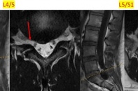 Đi khám vì đau thắt lưng, nam thanh niên 25 tuổi phát hiện hàng loạt vấn đề cơ xương khớp
