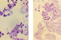 Cấp cứu tràn dịch màng phổi, phát hiện ung thư di căn ở bệnh nhân 66 tuổi