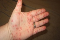 Tin mới y tế ngày 14/4: Gần 32.000 ca mắc sốt xuất huyết, cảnh báo nguy cơ gia tăng mạnh