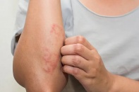 Tin mới y tế ngày 17/4: Cảnh báo biến chứng của zona thần kinh