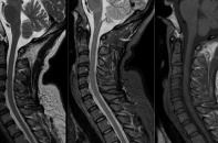 Cảnh báo bệnh lý ẩn sau những cơn đau đầu của dân công sở