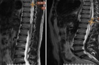 Đau thắt lưng tưởng đơn giản, phát hiện nhiều khối u trong ống đốt sống
