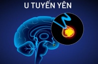 Tin mới y tế ngày 23/4: Tăng chiều cao bất thường ở tuổi trung niên, phát hiện u hiếm ở tuyến yên