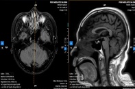 Bệnh Parkinson dễ nhầm với lão hóa tuổi già, nguy cơ bỏ lỡ giai đoạn điều trị hiệu quả