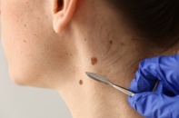 Tin mới y tế ngày 29/4: Các dấu hiệu cảnh báo ung thư da