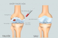 Tăng nặng cơn đau thoái hoá khớp do thừa cân, béo phì