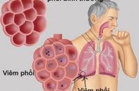 Chẩn đoán, điều trị viêm phổi: Tiêm phòng là yếu tố quan trọng