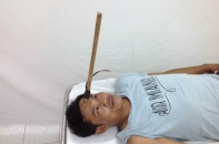“Cẩu tặc” bắn mũi chĩa dài 40 cm găm vào trán tuần tra nhân dân