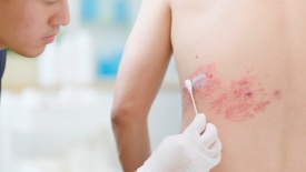 Phòng bệnh zona từ sớm để tránh những hệ lụy kéo dài