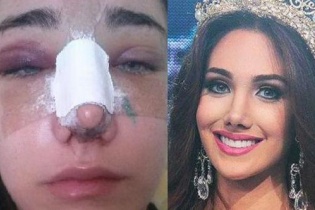 Tân Hoa hậu Quốc tế người Venezuala lộ ảnh phẫu thuật thẩm mỹ