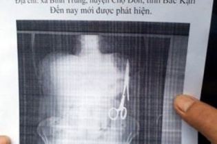 Bắc Kạn: Hy hữu bác sĩ bỏ quên kéo trong bụng bệnh nhân 18 năm