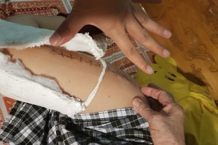 Vụ học sinh gãy chân: Điều tiếng để lại còn nặng nề
