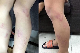 Tạm đình chỉ giáo viên dùng thước đánh tím chân học sinh