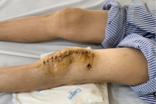 Bệnh nhân lao khớp gối đầu tiên được thay khớp gối nhân tạo