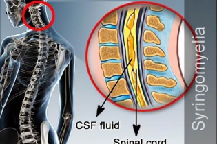 Bệnh hiếm “ẩn nấp” qua triệu chứng đau mỏi cổ vai gáy