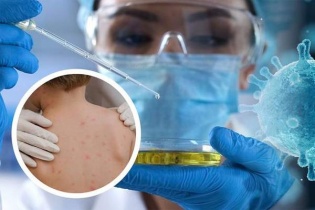 Tin mới về y tế ngày 28/5: Đậu mùa khỉ lan nhanh, WHO yêu cầu tăng giám sát