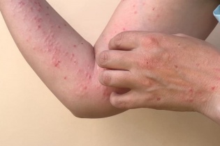 Thông tin mới về ca mắc đậu mùa khỉ đầu tiên