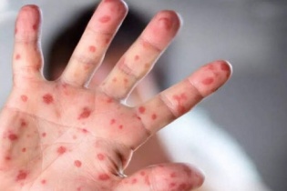 Vẫn chưa phát hiện ca bệnh đậu mùa khỉ thứ hai