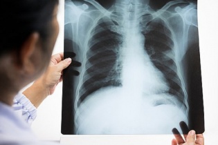 Nhiều kỹ thuật mới trong điều trị ung thư phổi