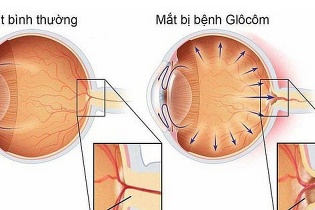 Tin mới về y tế ngày 14/3: Tầm soát và phát hiện sớm bệnh Glôcôm; Hà Nội tăng số ca mắc sốt xuất huyết và tay chân miệng 