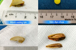 Tin mới về y tế ngày 17/3: Cảnh báo tai nạn nguy hiểm do hóc dị vật đường thở ở trẻ