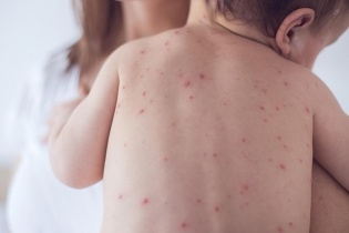 Tin mới về y tế ngày 22/3: Tăng nhanh số trẻ mắc thủy đậu tại Hà Nội; Liên tiếp các ca tử vong nghi chó dại cắn