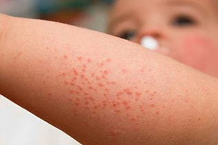 Nhiều ca sốt xuất huyết nặng mới nhập viện điều trị