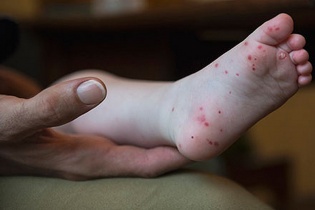Tin mới về y tế ngày 4/4: Số ca mắc thủy đậu, tay chân miệng tại Hà Nội tăng; TP.HCM triển khai đấu thầu thuốc tập trung