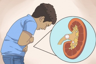 Cảnh báo bệnh lý sỏi thận ở trẻ em