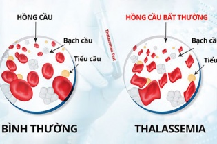 Gánh nặng bệnh tan máu bẩm sinh 