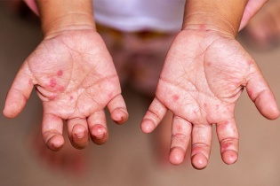 Tin mới về y tế ngày 9/6: Cẩn trọng với bệnh tay chân miệng