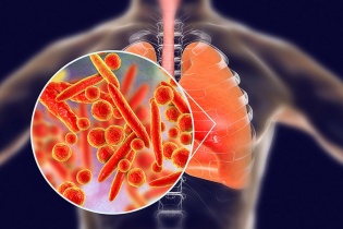 Tin mới về y tế ngày 27/6: Gia tăng trẻ viêm phổi do vi khuẩn Mycoplasma, nguy cơ sức khoẻ vì tự ý sử dụng thuốc