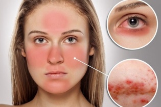 Nhiều người chưa biết tới bệnh lupus ban đỏ