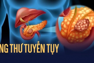 Cảnh báo những dấu hiệu của ung thư tuyến tụy