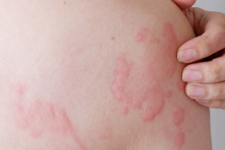 Bị mày đay có phải do suy giảm chức năng gan?