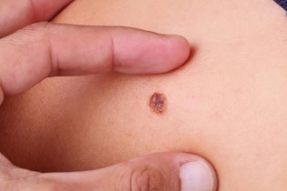 Phát hiện ung thư từ dấu hiệu không ngờ tới