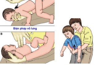 Nghỉ hè, phòng ngừa trẻ bị dị vật tai mũi họng