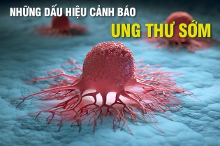 Những dấu hiệu cảnh báo ung thư sớm